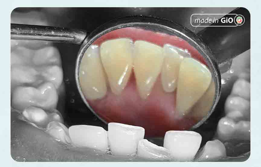 KESEHATAN GIGI: Manfaat scaling gigi yaitu dapat memperbaiki penampilan gigi dan membantu mencegah bau mulut. (GIO DENTAL FOR RADAR JOGJA)