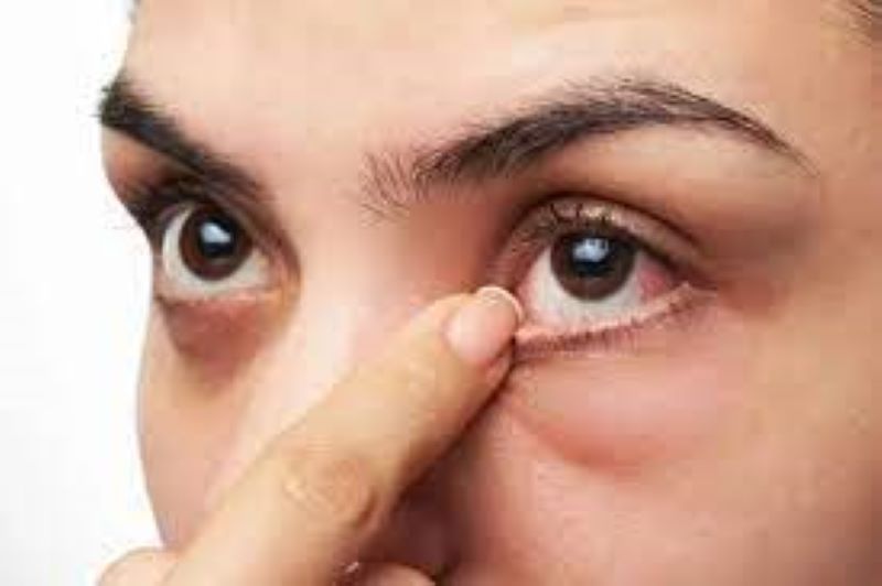 lustrasi gambar mata memerah karena mata kering (jawa pos)