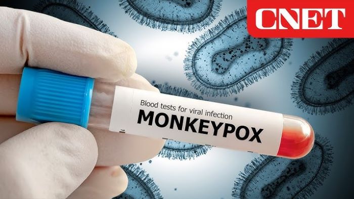 ilustrasi monkey pox atau cacar monyet