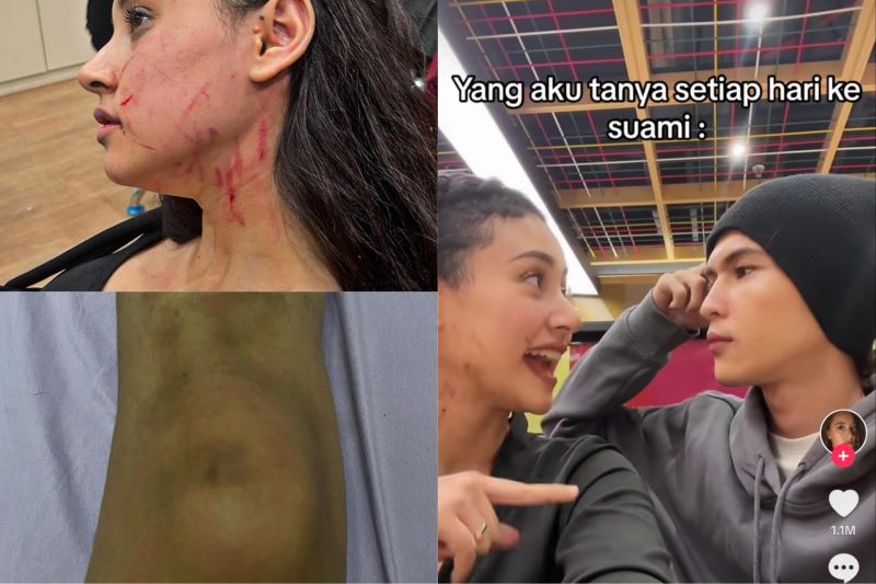 Lebam di beberapa bagian tubuh Afifah Riyad. (Instagram dan TikTok /@afifahriyad)