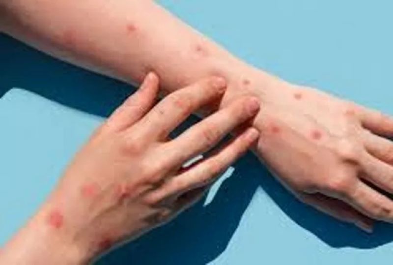 Ilustrasi gejala monkeypox. (Website/News Medical)