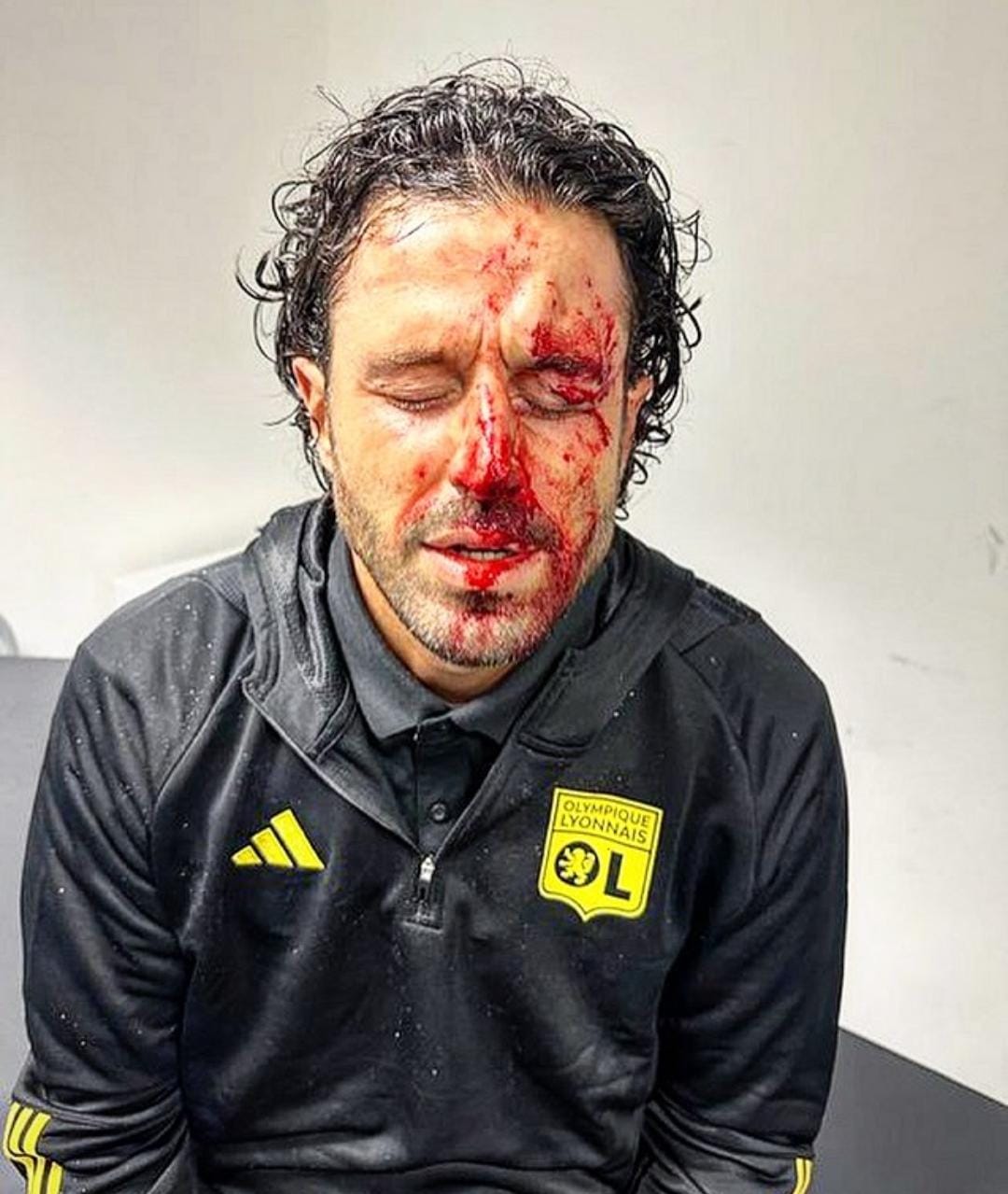 Wajah Fabio Grosso dipenuhi darah akibat lemparan batu yang dilemparkan fans Marseille (sumber foto lequipe)