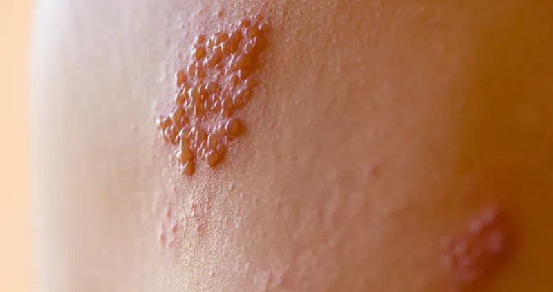 Herpes Zoster pada kulit. (halodoc.com)