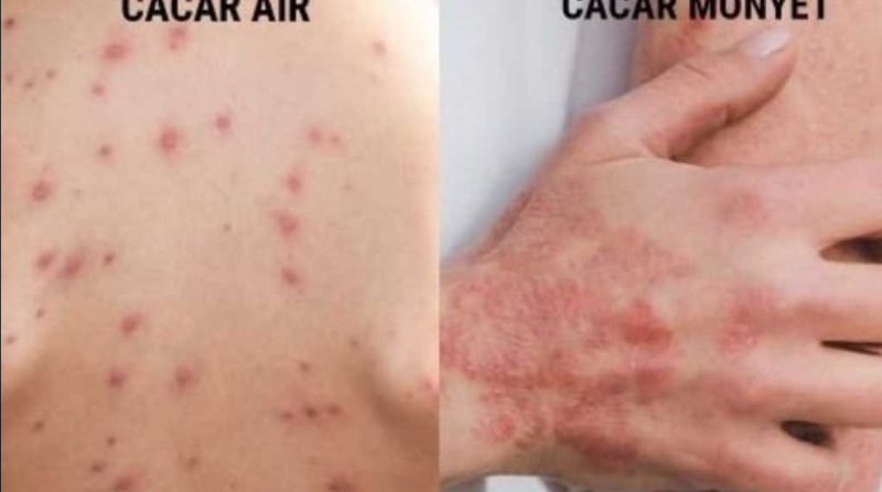 Perbedaan Cacar Air dan Cacar Monyet. (celebesmedia.id)