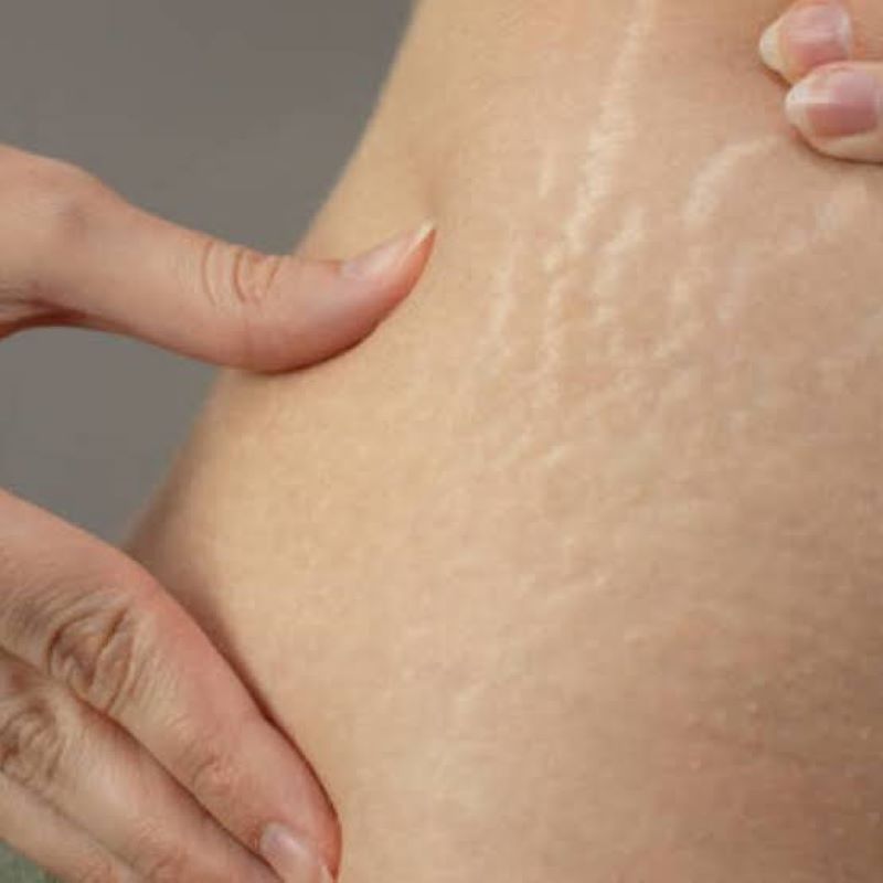 Stretch mark pada kulit. (blog.avoskinbeauty.com)