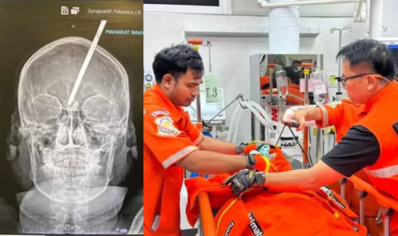 Hasil CT scan kepala Chayathorn (kiri) dan Chayathorn dalam penanganan petugas medis (kanan). (Faceebook)