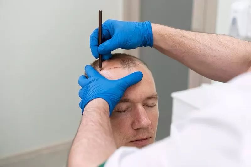 Ilustrasi transplantasi rambut. (Freepik.com)