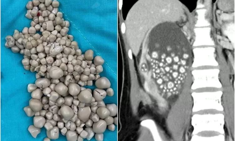 Lebih dari 300 batu ginjal yang terbentuk di tubuh wanita asal Taiwan. (The Straits Times)