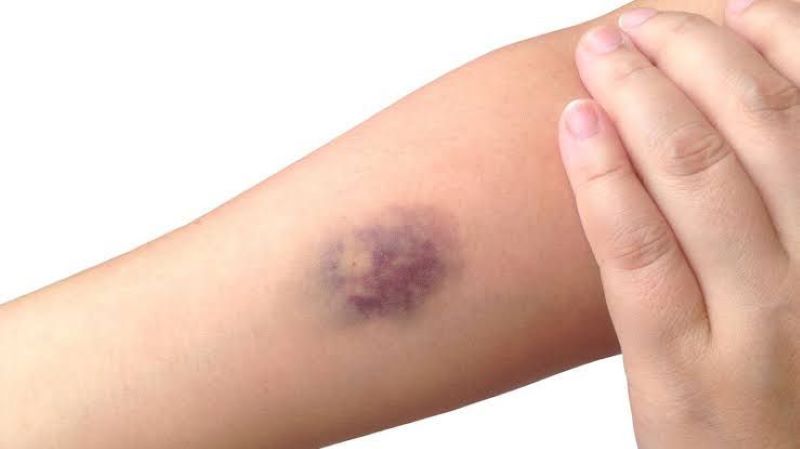 Ilustrasi tubuh mengalami lebam. (Google/@klikdokter)