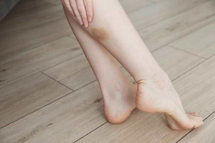 ilustrasi memar yang timbul di kaki(Foto : alodokter.com )
