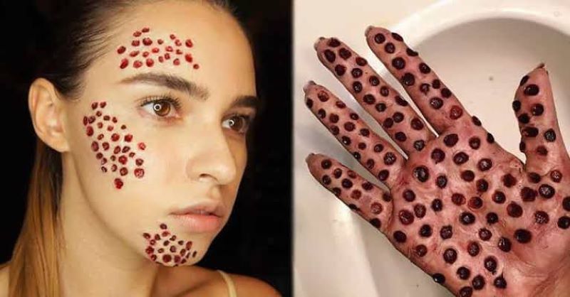 Penyakit Tryphobia.
