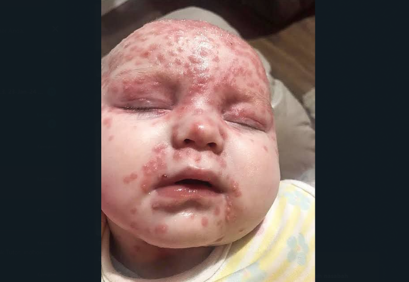 Penyakit herpes pada bayi.