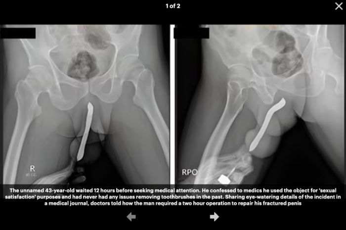 Tangkapan layar Journal of Surgery Case Reports yang memperlihatkan hasil rontgent seorang pria yang memasukkan sikat gigi ke penis.
