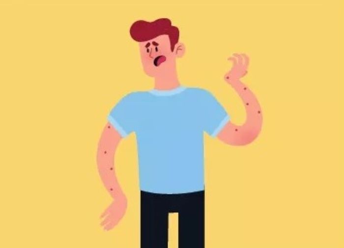 Ilustrasi Antraks menyerang manusia