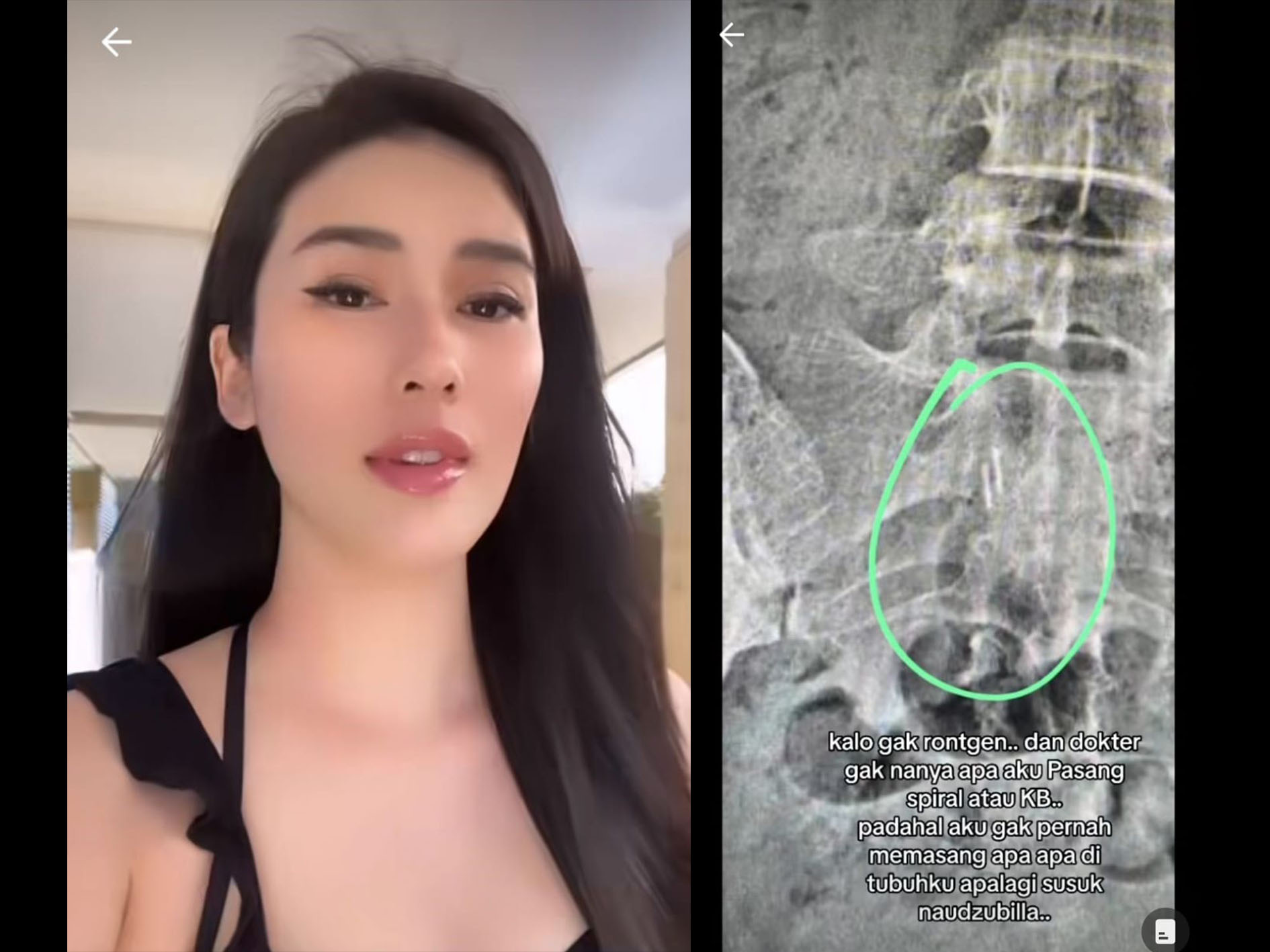 Artis Stevie Agnecya sebelum meninggal dunia memposting hasil rontgen ada benda aneh di dalam tubuhnya diduga karena ilmu sihir.