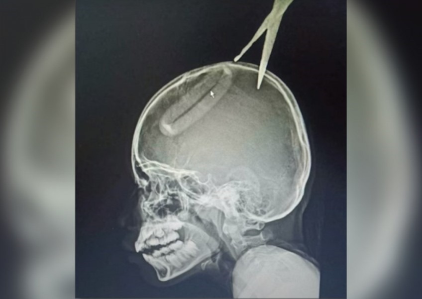 Foto sinar x perlihatkan sebuah gunting tertancap pada tulang tengkorak seorang anak perempuan di Thailand