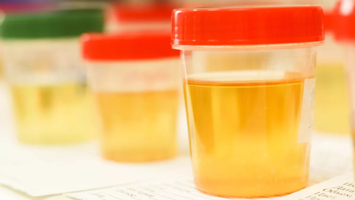 urine berwarna kuning