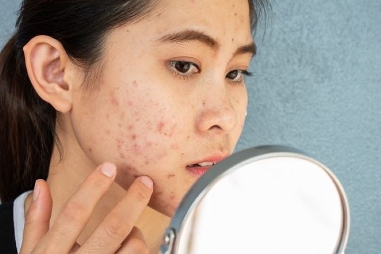 Mengapa Jerawat Membutuhkan Waktu Lama untuk Sembuh? (Sumber foto: web, Alodokter)