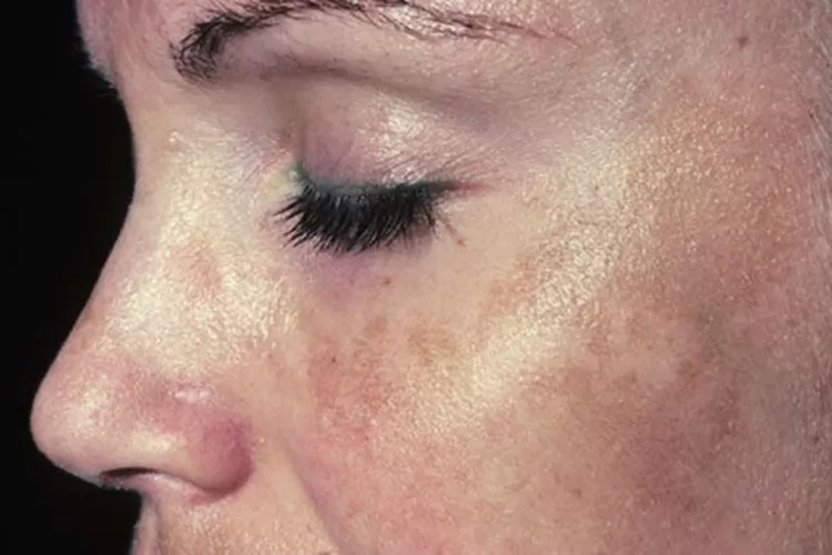 kondisi kulit yang ditandai dengan munculnya bintik-bintik coklat atau abu-abu pada wajah yang disebut Melasma