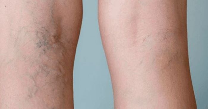 Ilustrasi orang yang terkena varises