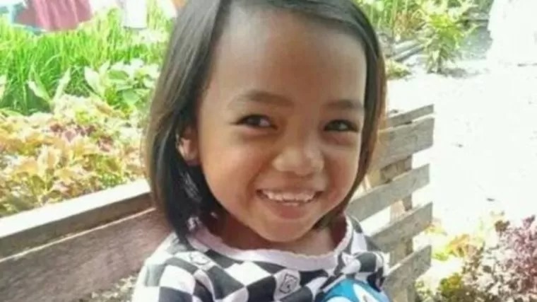 Aldelia Rahma siswi SD di Padang Pariaman yang dibakar oleh temannya