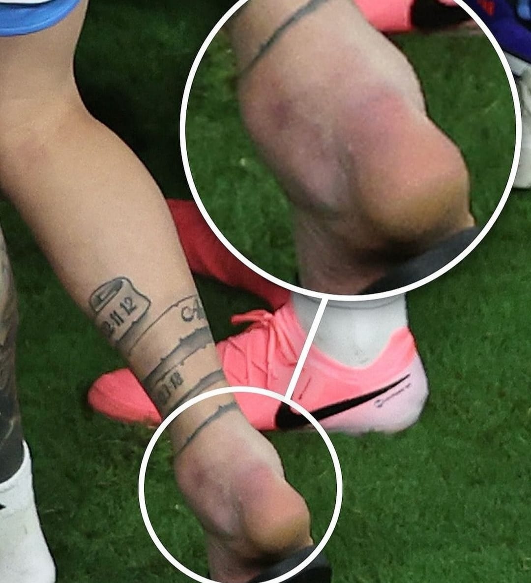 Kondisi kaki Lionel Messi yang bengkak usai mendapatkan cedera saat laga final Copa America antara Argentina kontra Kolombia (ig livewherewego)