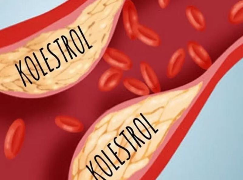 Ilustrasi Kolestrol.