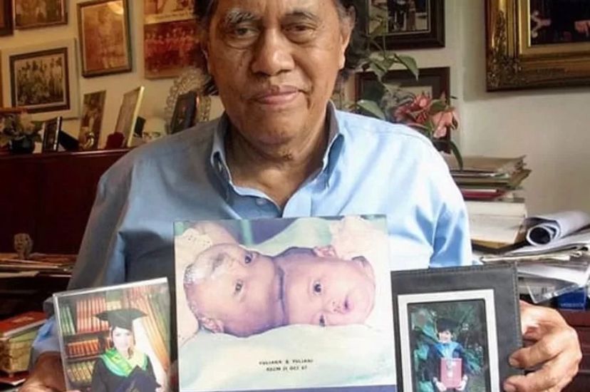 Foto Dokter memegang foto pasien kembar siamnya, Yuliana dan Yuliani. (Instagram @farezhaputera1499)
