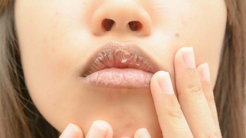 Ilustrasi wanita dengan bibir kering.