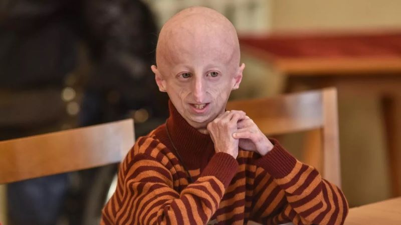 Sammy Basso, penyintas penyakit Progeria meninggal dunia di usia 28 tahun.