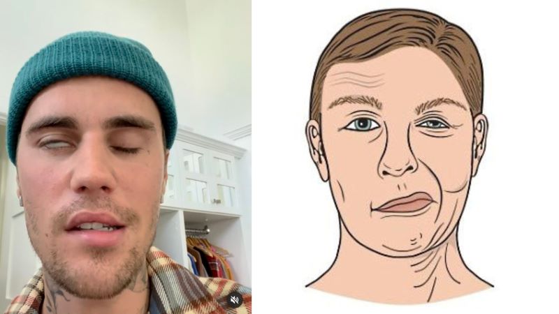 Justin Biebier (kiri) Ilustrasi Bells Palsy (kanan).