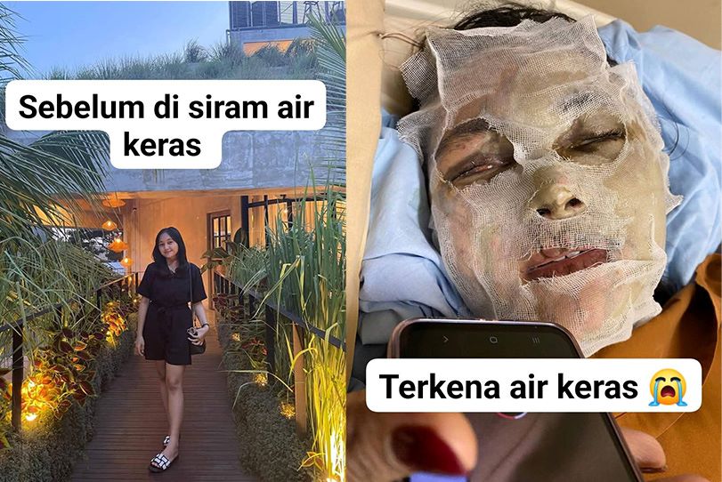 Mahasiswi korban penyiraman air keras.