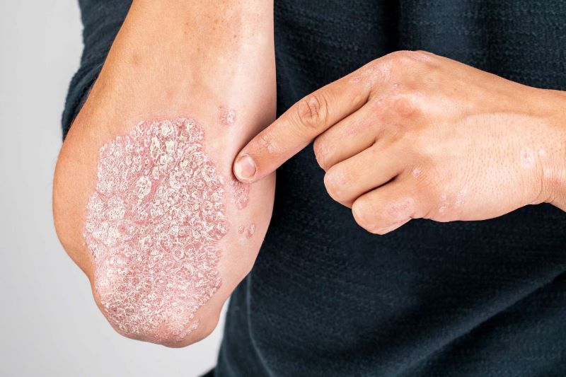 Psoriasis, penyakit kulit.