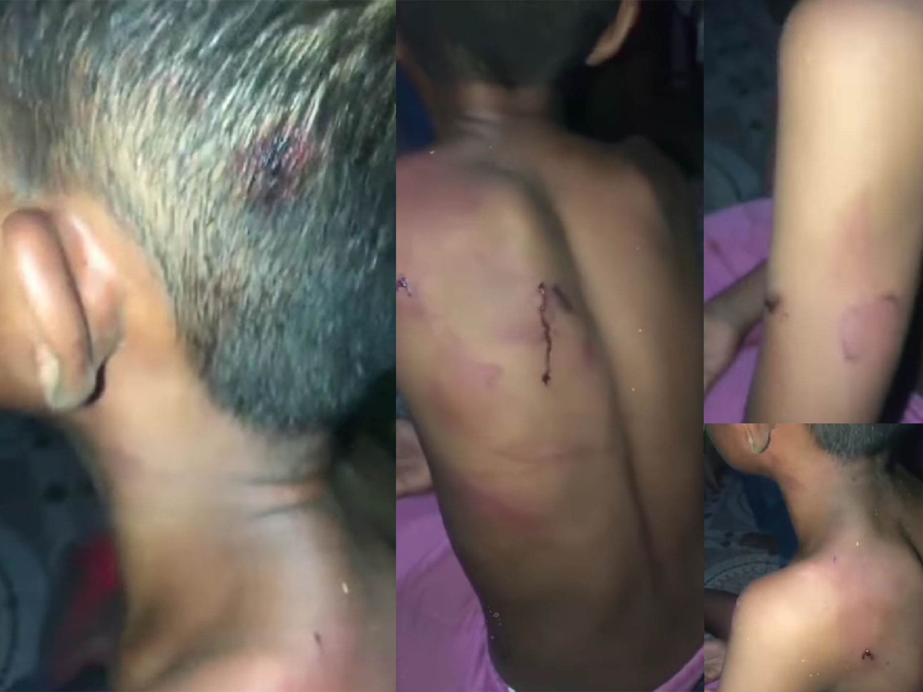 Gior, Bocah SD asal kupang menerima perlakuan kasar dari neneknya, tubuhnya penuh luka-luka.