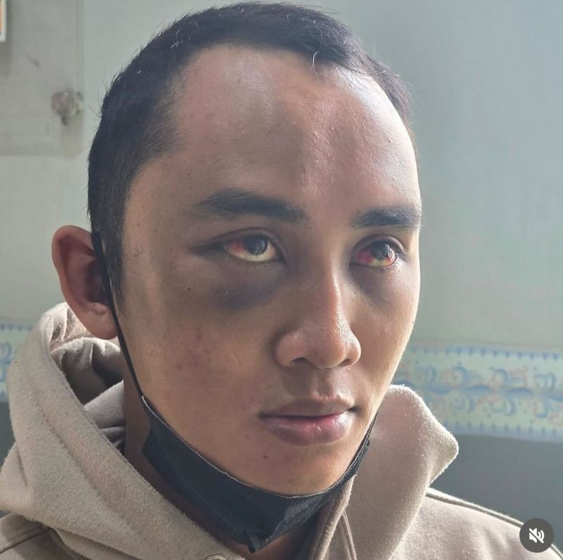 Gambar seorang ASN di Bandung Barat, jadi korban KDRT yang di lakukan oleh istrinya sendiri hingga babak beluk.