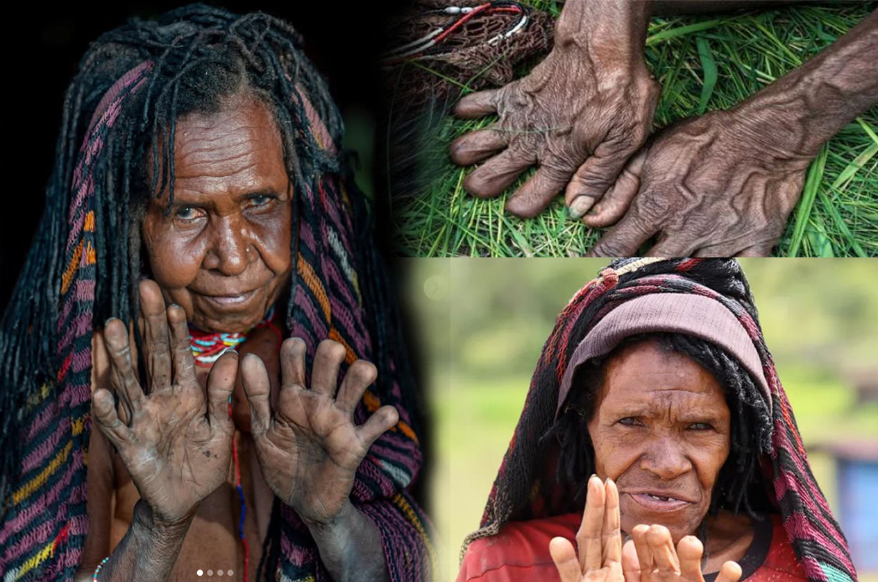 Tradisi pemotongan jari atau Iki Palek di Papua.