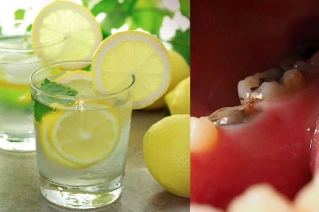 Ilustrasi gigi rusak akibat minum air  lemon berlebihan.