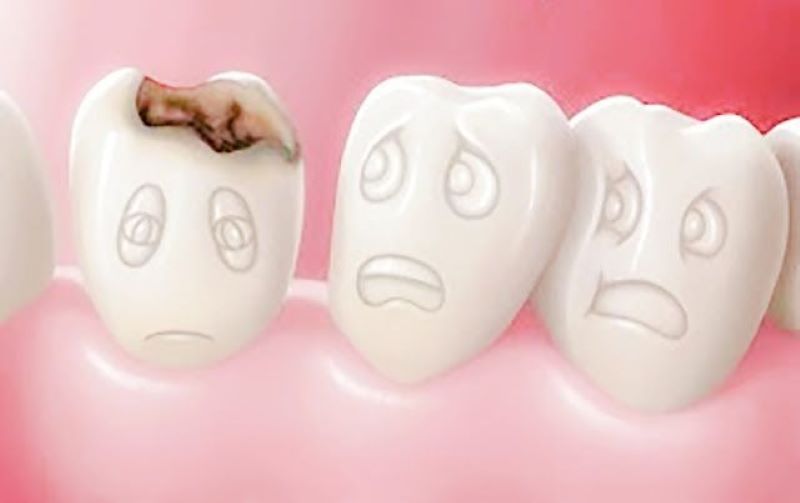 Gigi berlubang bisa merusak senyuman.