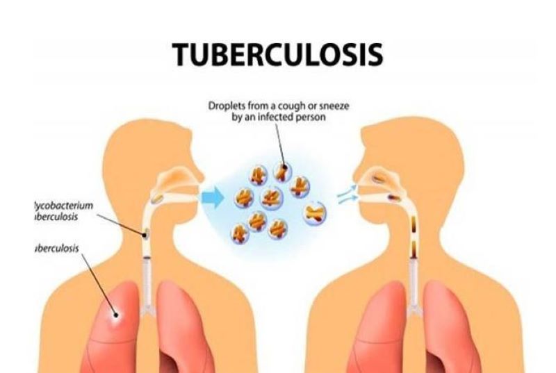 Ilustrasi, penderita tuberculosis.