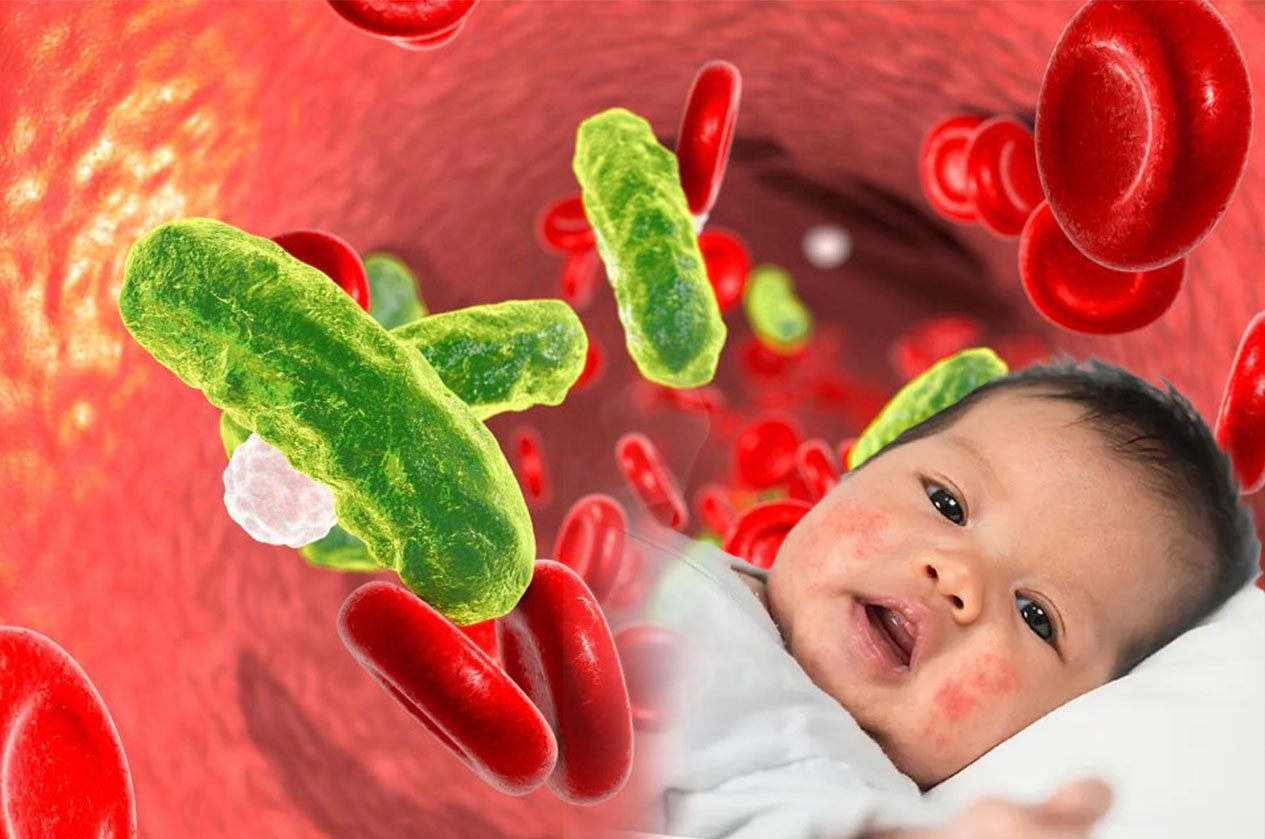 Penyakit Sepsis pada anak.