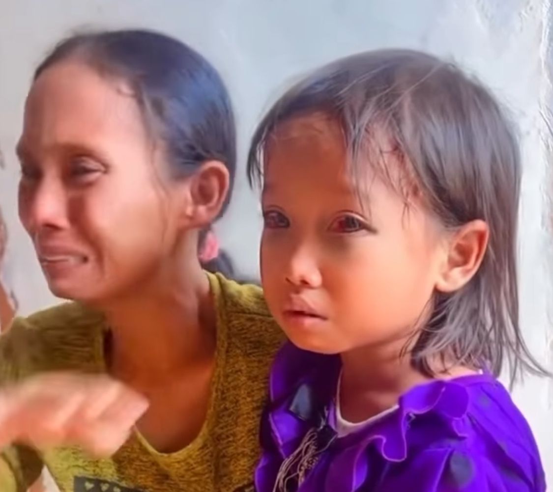 Siswi SD yang alami mata lebam diduga alami kekerasan di sekolah.
