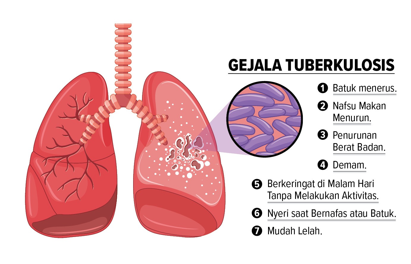 Gejala TBC