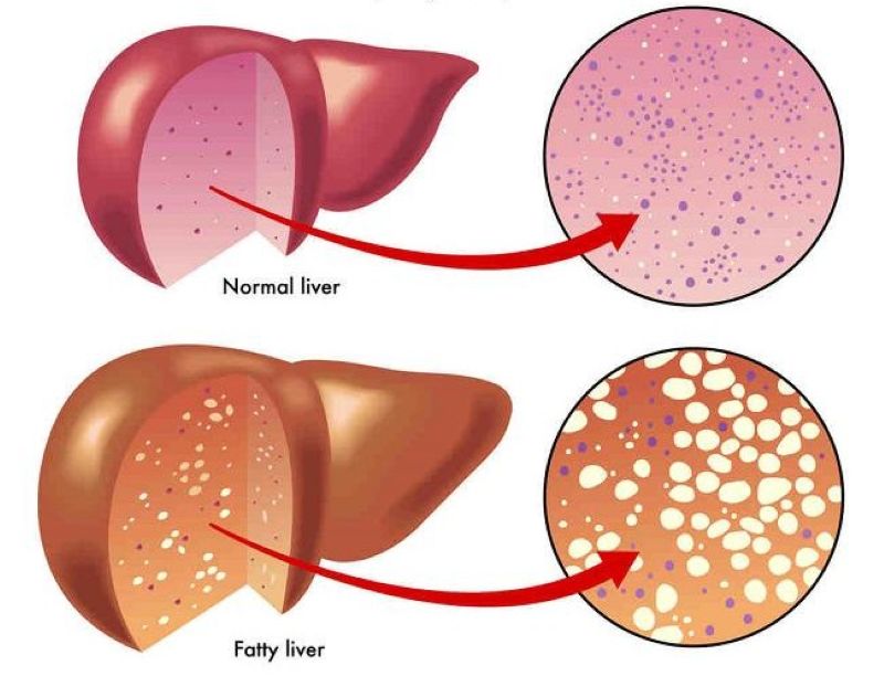  Ilustrasi hati atau liver yang masih baik dan yang sudah terkerubung lemak.