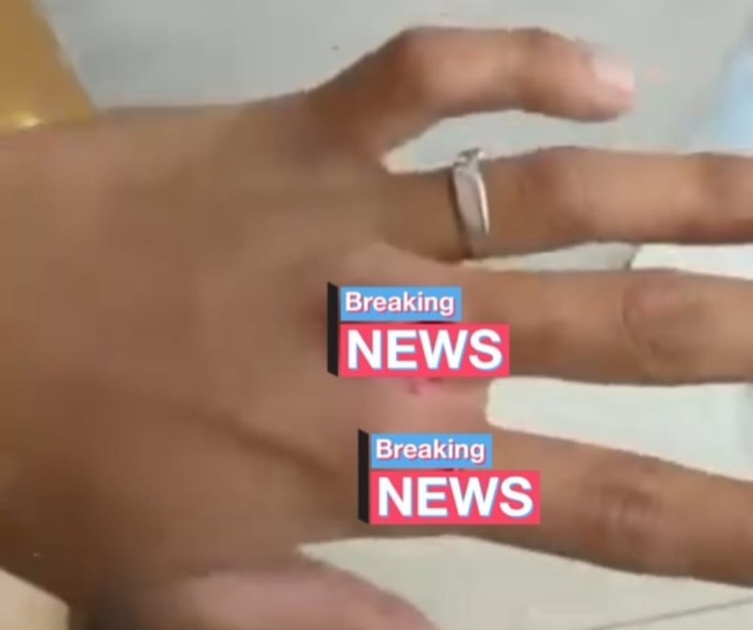 Kondisi tangan pebalap asal Bantul, Aldi Satya Mahendra setelah alami insiden tabrak lari di perempat Pingit pada Rabu (18/3) pagi
