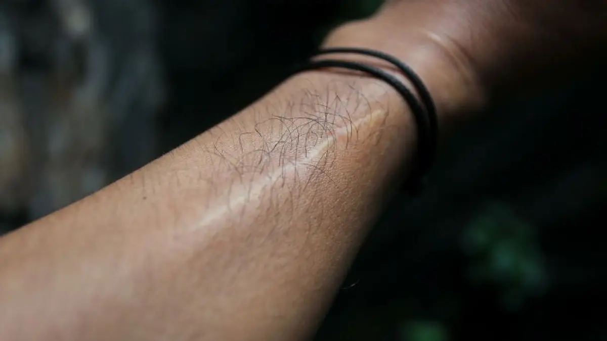 TIMBUL: Bekas luka bisa disamarkan dengan melakukan perawatan kulit lewat laser untuk menyamarkannya. (GUNTUR AGA TIRTANA/RADAR JOGJA)
