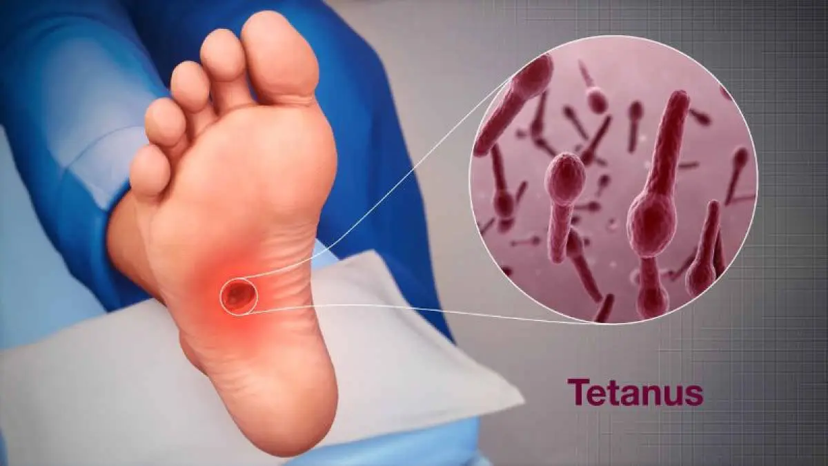 Ilustrasi terkena Tetanus.