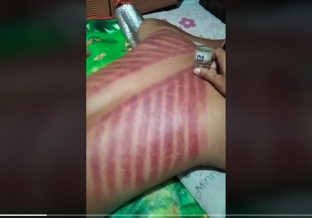 Kerokan dengan botol balsem kaca