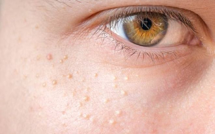 Milia adalah benjolan kecil berwarna putih atau kekuningan yang sering muncul di wajah, terutama di area sekitar mata, pipi, atau hidung.