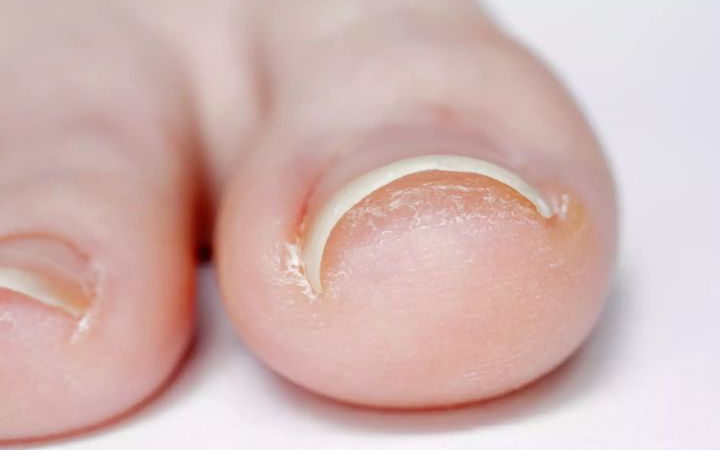 Kaki cantengan, atau dalam istilah medis disebut ingrown toenail, adalah kondisi ketika sisi atau ujung kuku tumbuh masuk ke dalam kulit di sekitarnya.