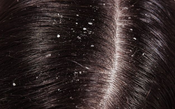 Ketombe merupakan salah satu masalah rambut yang umum dialami oleh banyak orang.